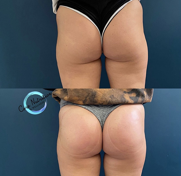 Butt Cupping